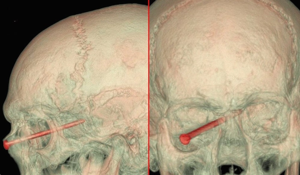 Guy Gets Three Inch Nail Through His Eyeball; Miraculously Survives