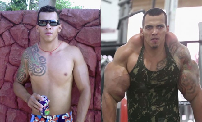 synthol injectat în penis