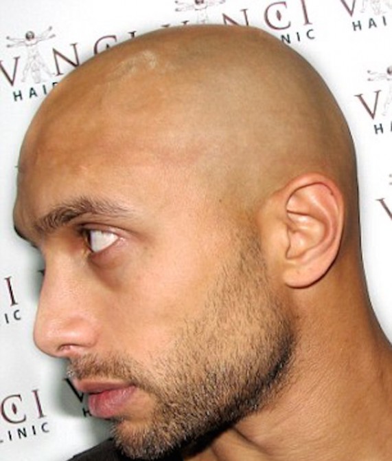 Bald Men Are Getting Head Tattoos To Hide Their Baldness – Sick Chirpse