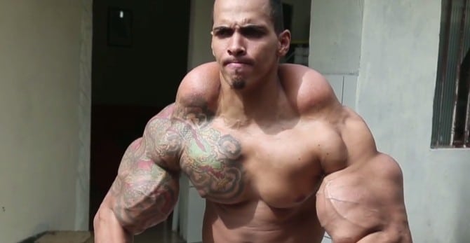 Synthol Pain