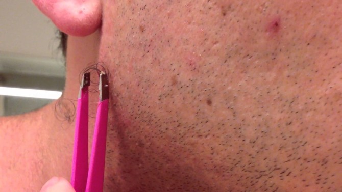 World's Largest Ingrown Hair