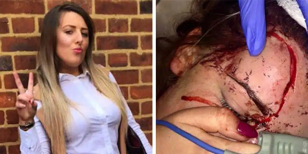 Calls To Boycott ‘The Venue’ In New Cross After Girl Suffers Horrific Head Injury From Bouncer