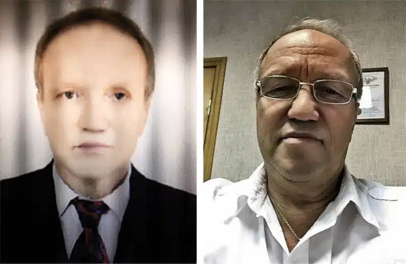 White Man Turns Black After Liver Transplant