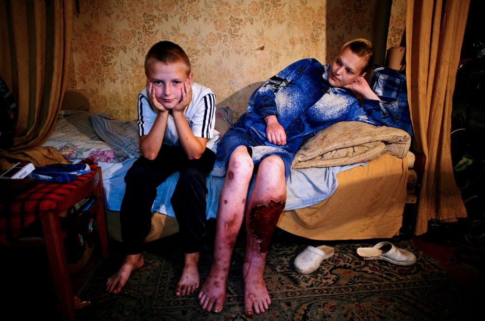 Brent Stirton - AIDS Ukraine