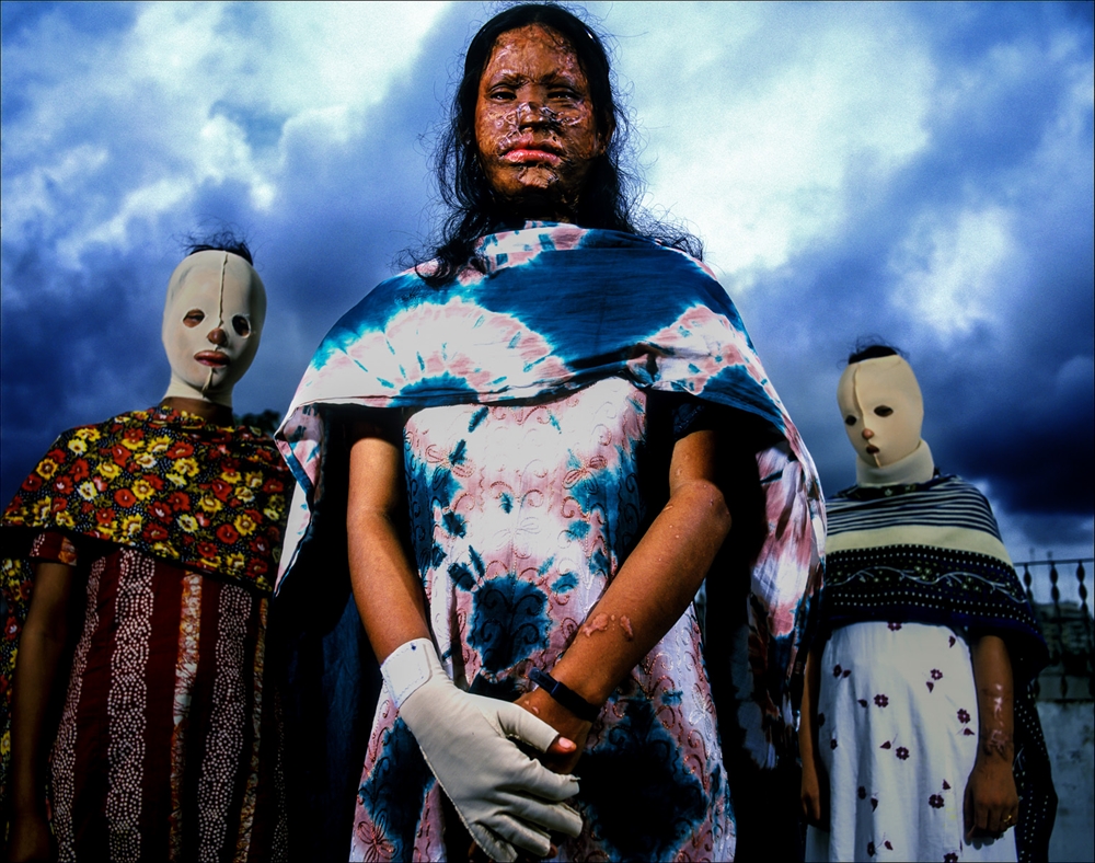 Brent Stirton - Acid Attacks