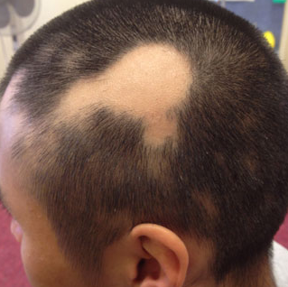 Traction Alopecia