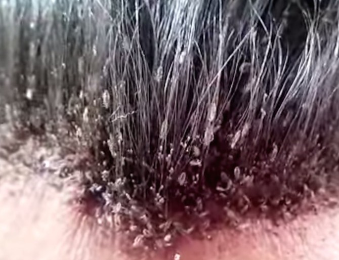 World's Worst Head Lice Infestation