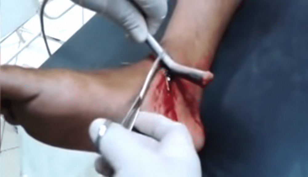 This Footage Of A Stingray Barb Being Removed From A Guy’s Leg Is Completely Brutal (NSFW)