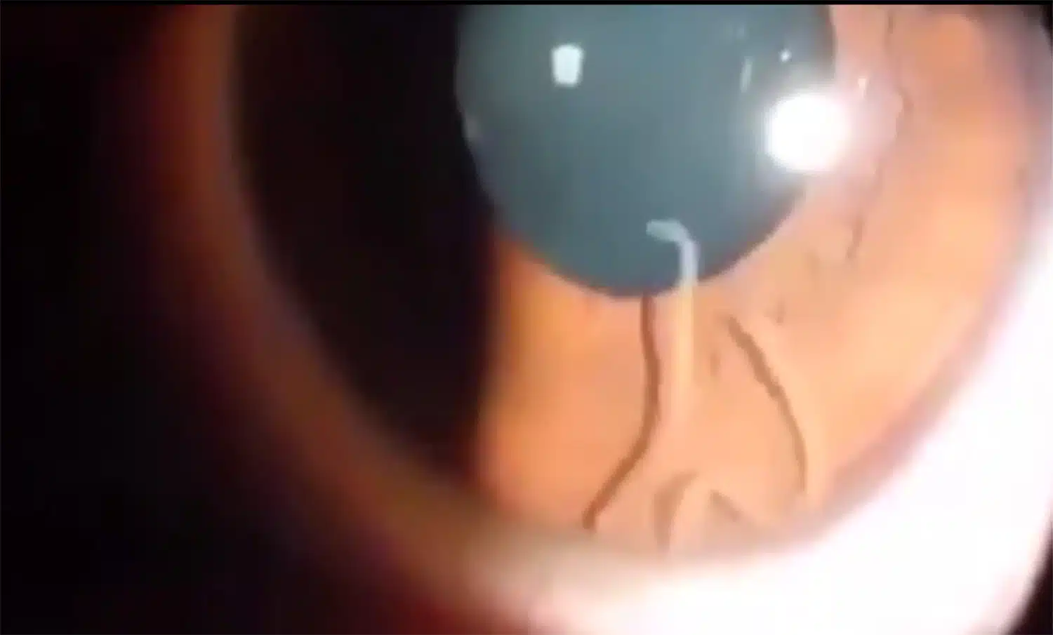 This Video Of A Woman With A Worm In Her Eye Is The Worst Thing You’ll See All Day