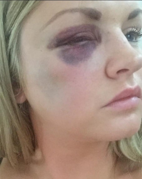 Samantha Dewar, from Macclesfield, was attacked by friend's groom on wedding day when she was bridesmaid