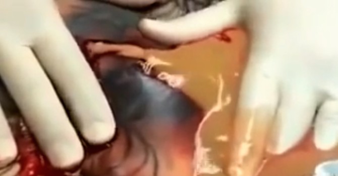 Tattoo Infection Drainage