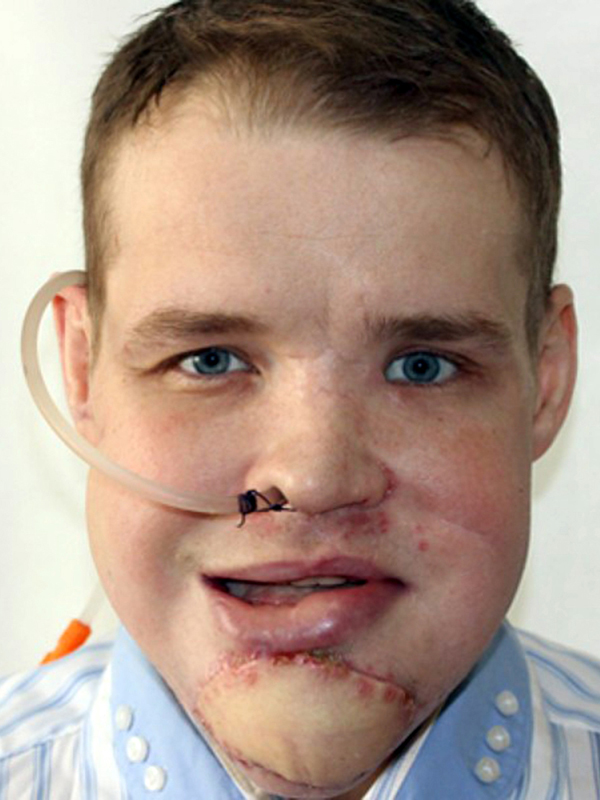 Pic shows: the reconstructed face of Aleksey Koptyakov. A man who thought he was going to die when he felt the bones in his head breaking as he was bitten by a bear has had his skull reconstructed with part of his pelvis. The horrific attack was later compared to the film 'Revenant' in which a bear horrendously mauled 29-year-old Alexei Koptyakov. He only escaped death when he passed out after a second mauling by the infuriated bear, and was so horrendously injured that several cars refused to stop after he had managed to crawl to a nearby road. He said: "I was walking back from a hunt when I heard my dog Thunder pickup a scent, and start barking. I thought it might be a bird and when I checked it out I found him standing outside a small cave. But inside there was a huge bear, and when it came out it went straight for me." He said that he had attempted to step backwards and slipped on the wet stone, with his gun going off in the process. He added: "I thought the sound would scare the bear off, but it actually made it even more angry and it came at me even faster. I tried to reload the gun, but by then it was already on me. I managed to get one blow at the bear hitting it with the gun, and then it sank its teeth into my head. "I tried to put my hands on my head, but it bit both of my hands and I couldn't use them after that to defend myself as it bit me on the head again. I curled into a ball, and could hear my bones cracking. That point I didn't expect to live any longer, I was hoping it would eat me quickly so I wouldn't suffer too much." He said however that the bear had been determined to apparently make him suffer, and continue to maul him for several minutes before then dropping him having extracted its revenge, and lumbering off into the forest. But seconds later it had rushed back out of the forest and attacked him again. He said it was difficult to remember much after that, but he remembers the bear leaving for the second time, and seeing the snow