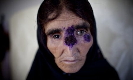 Flesh Eating Disease 1