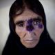 Flesh Eating Disease 1