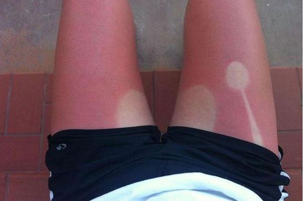 British Sunburn