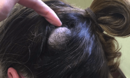 Giant Cyst