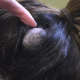 Giant Cyst