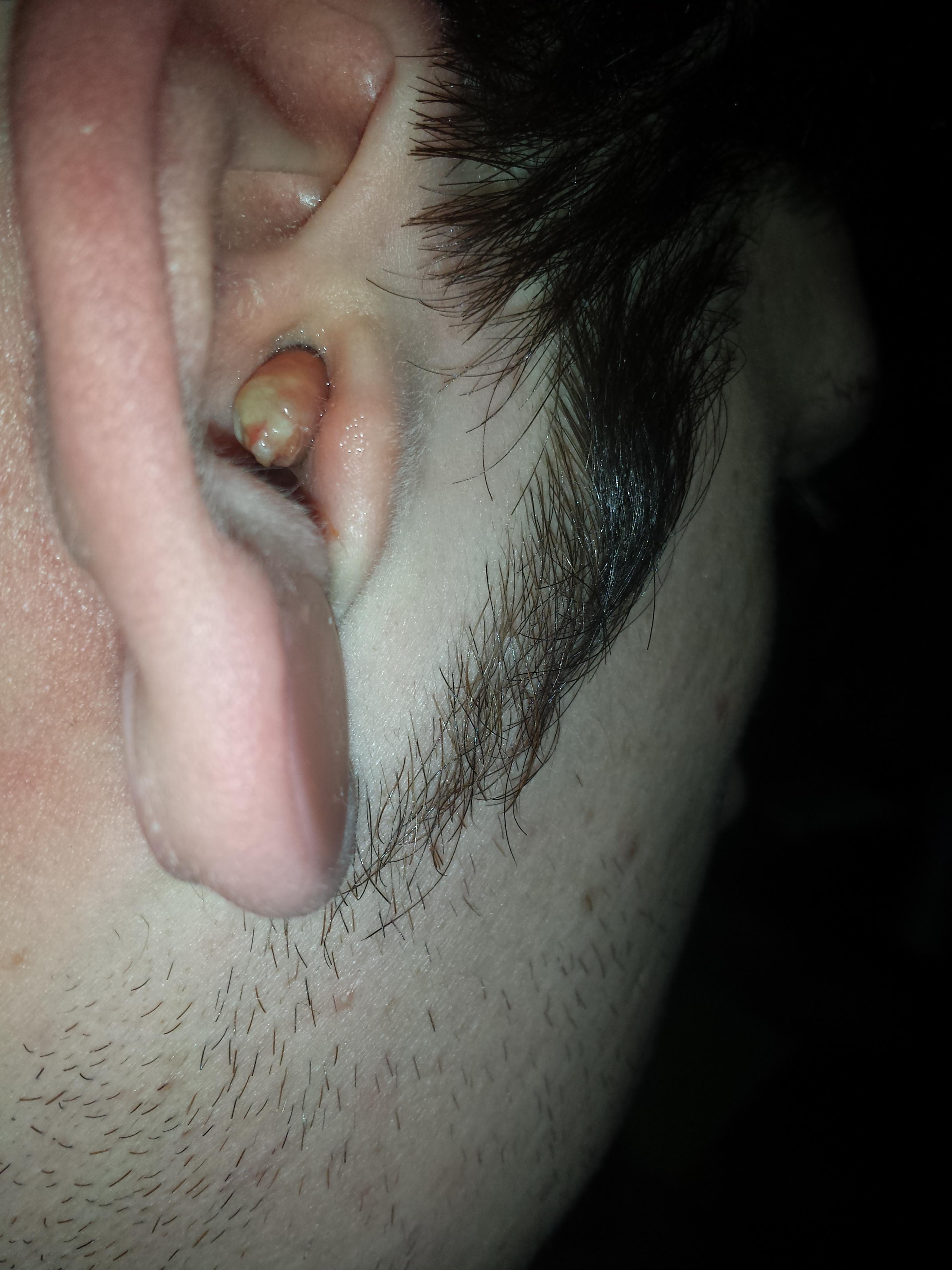 Ear Infection 1