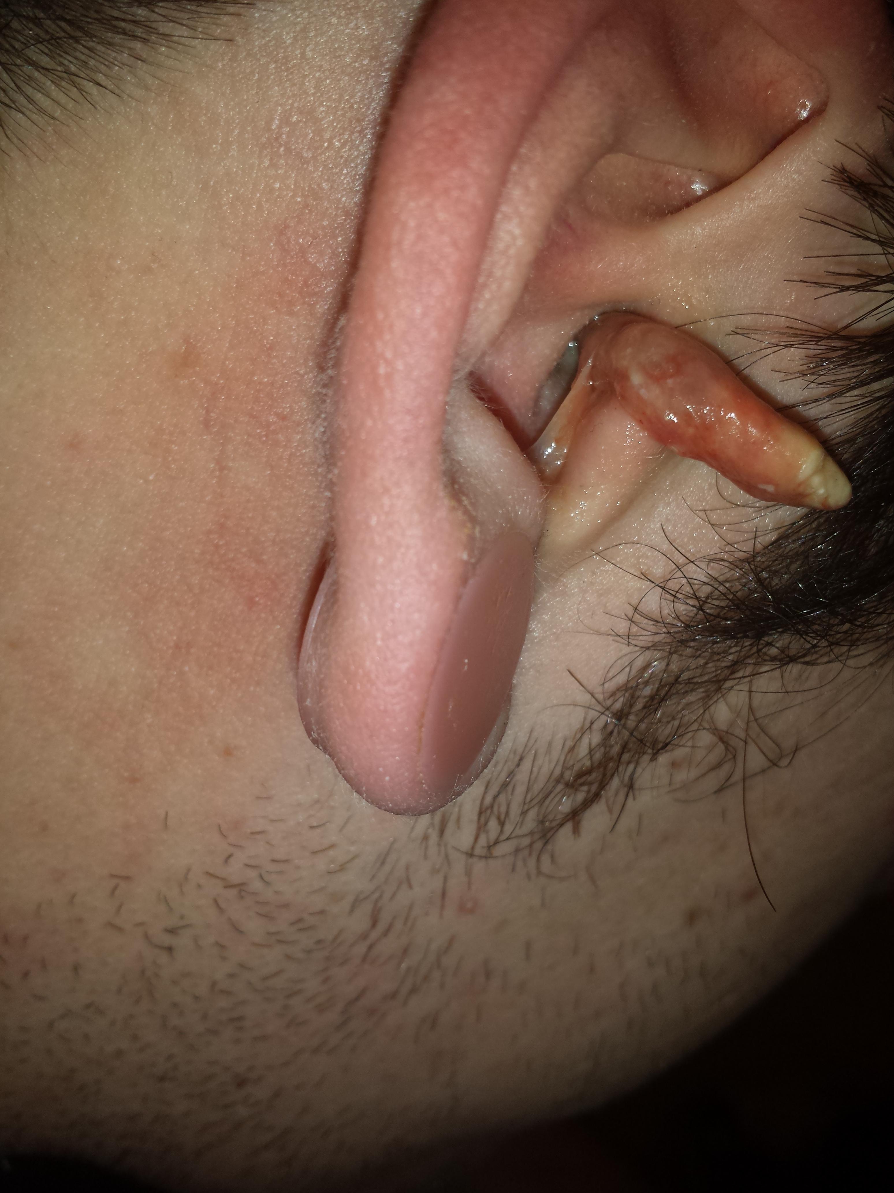 Ear Infection 4