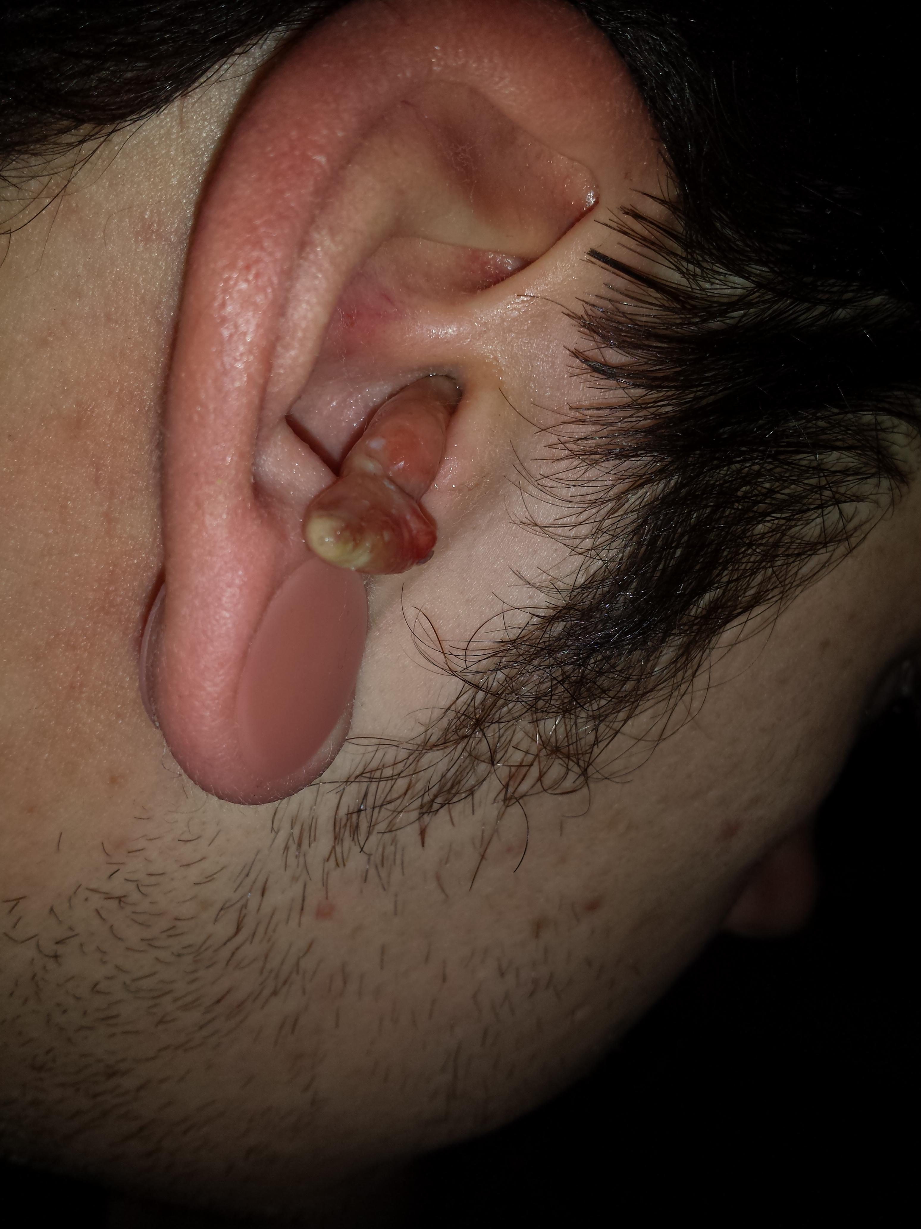 Ear Infection 6