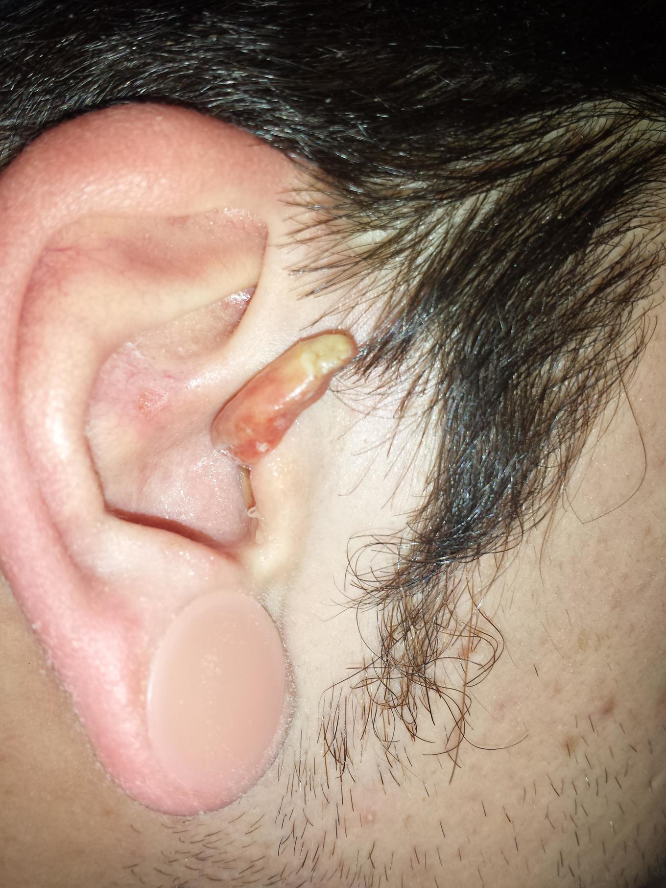 Ear Infection 7