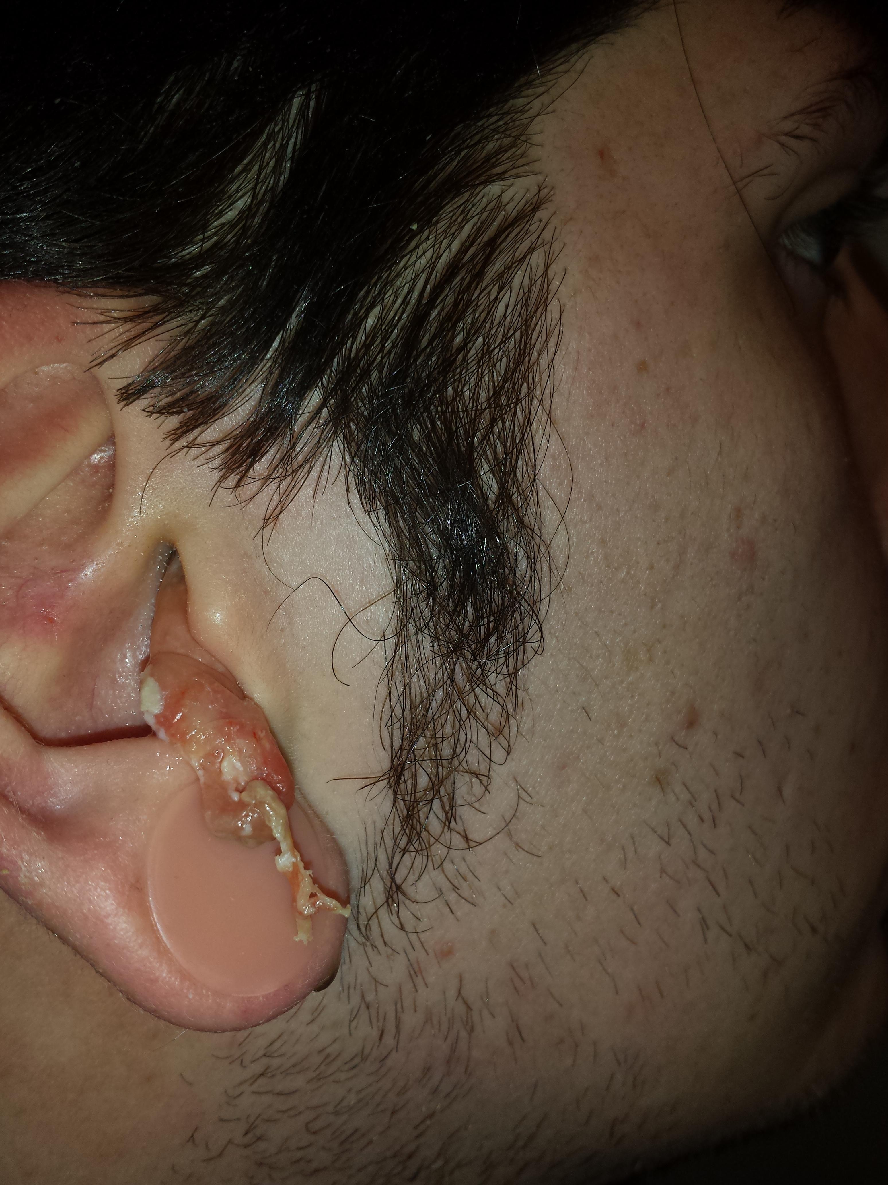Ear Infection 9
