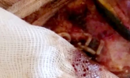 Maggots Eating PAtiend