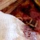 Maggots Eating PAtiend