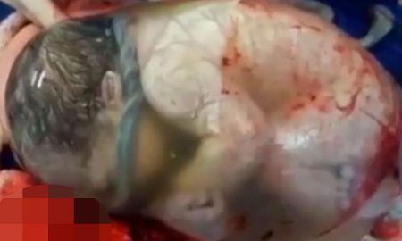 Baby Inside Amniotic Sack