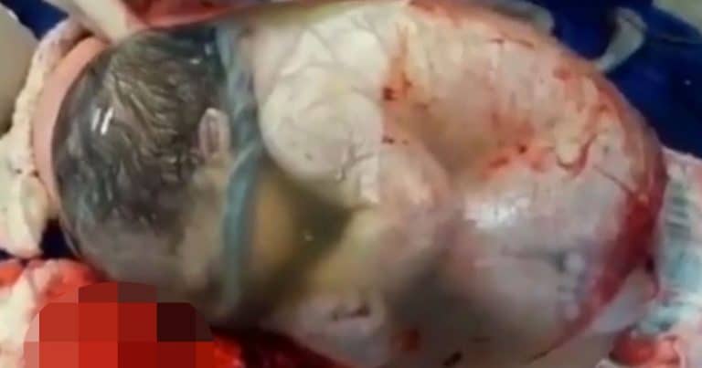 Baby Inside Amniotic Sack