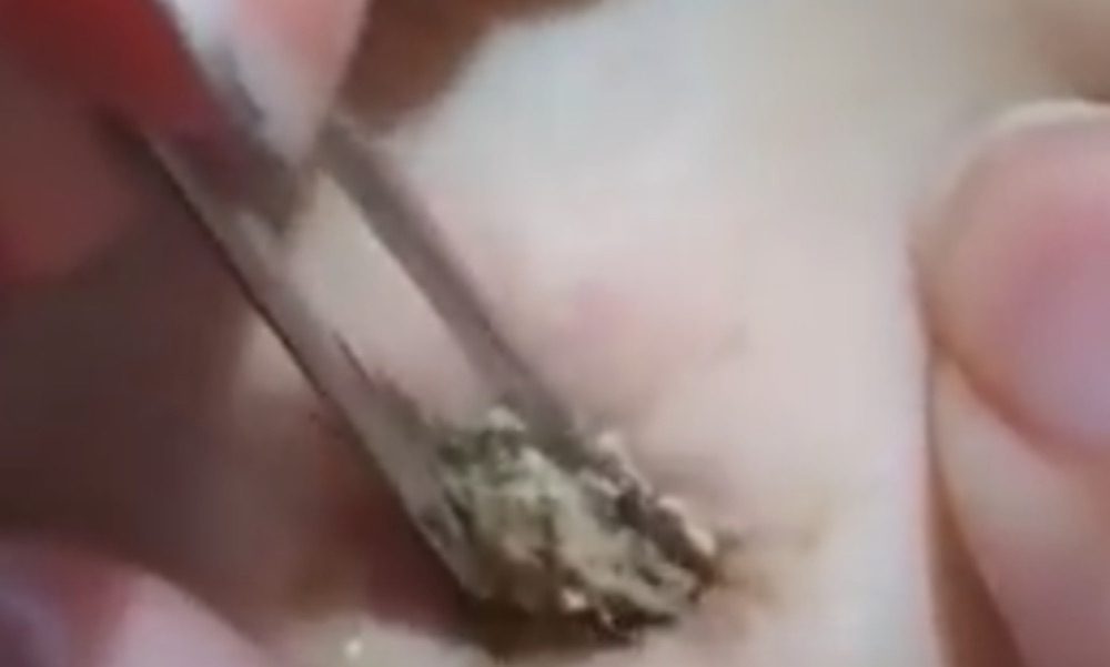 Giant Blackhead Belly Button