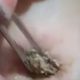 Giant Blackhead Belly Button