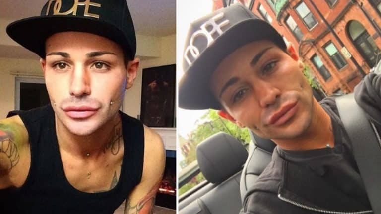 This Guy Spent £45,000 On 100 Plastic Surgeries To Triple The Size Of His Butt (NSFW)