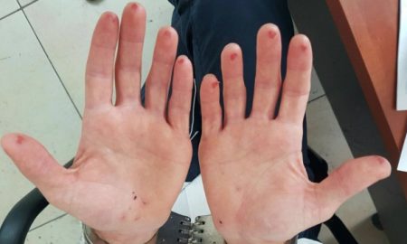 Sliced fingertips