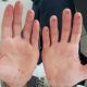 Sliced fingertips