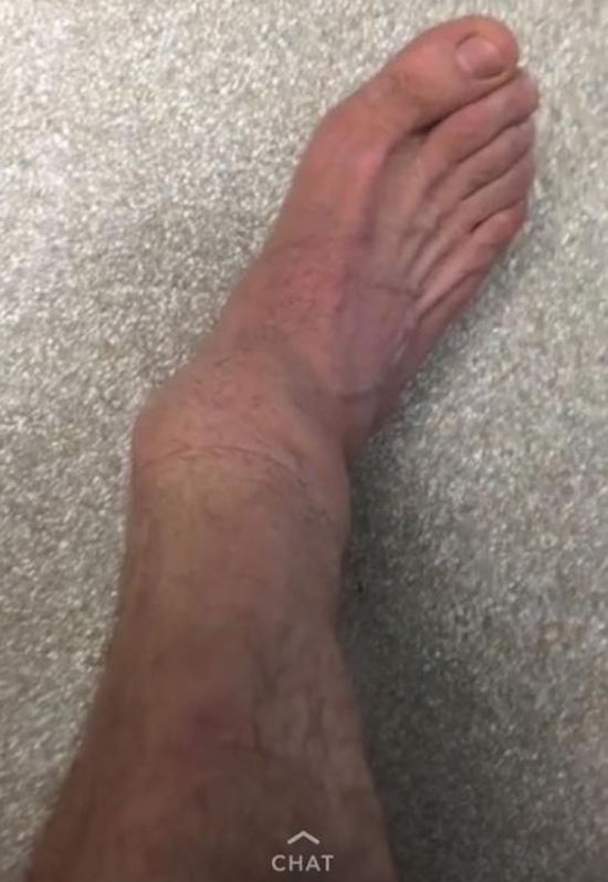 Steve-O Ankle