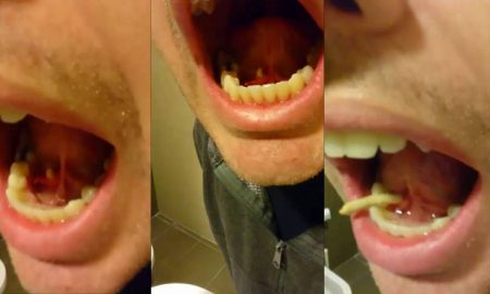 salivary-stone-brandon-douglas
