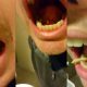 salivary-stone-brandon-douglas