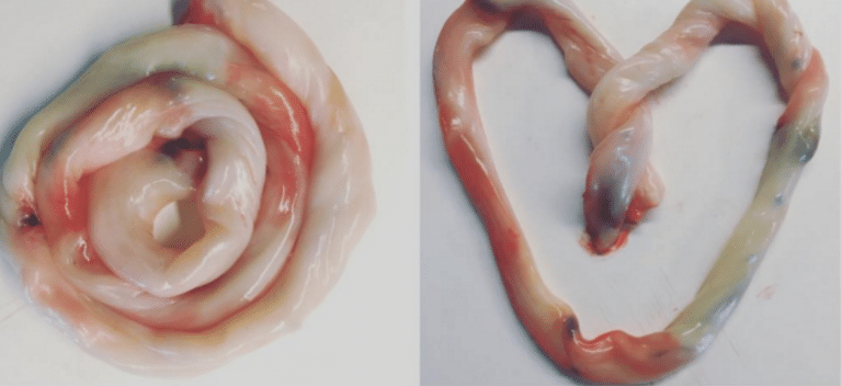 Loads Of New Mums Are Turning Their Babies’ Umbilical Cords Into Pieces Of Art