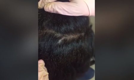 head-lice