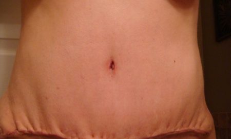 woman-stomach-surgery
