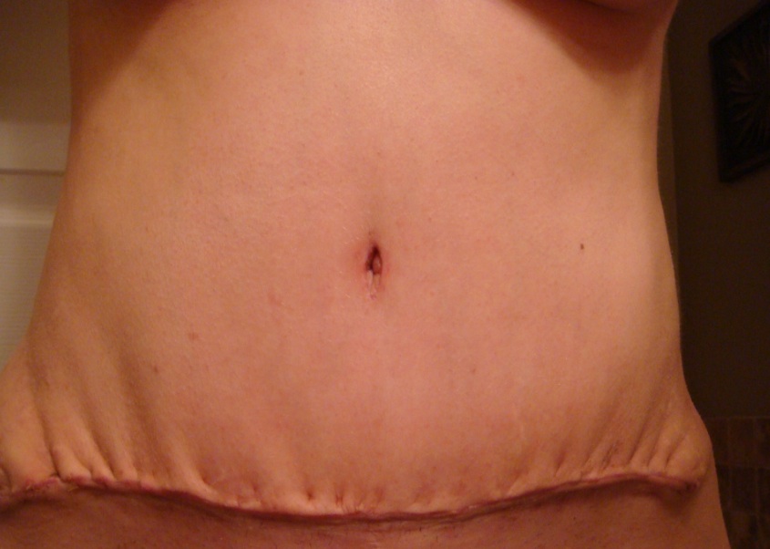 woman-stomach-surgery