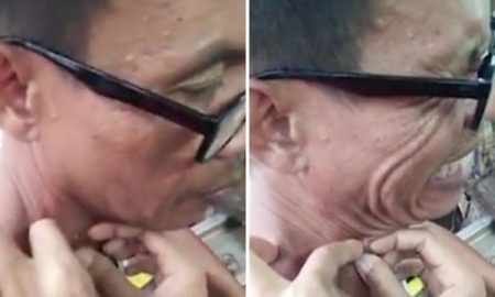 blackhead-pop