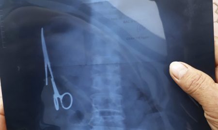 scissors-in-stomach