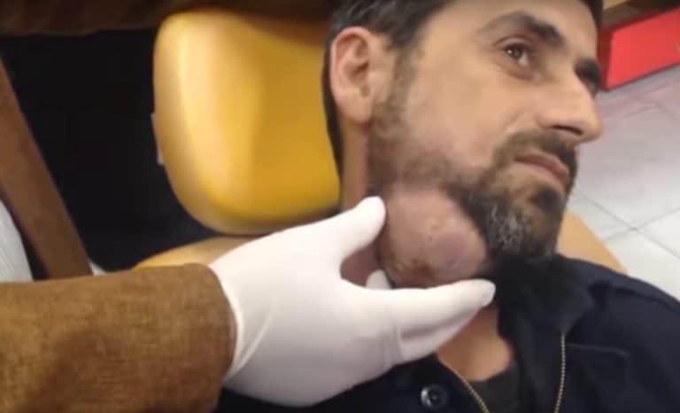 Cyst popping