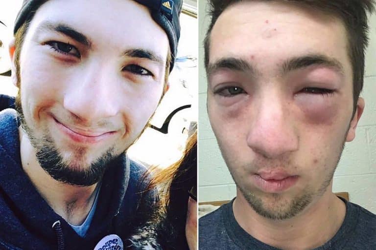 Student With Severe Peanut Allergy Gets Brutally Pranked By Housemates