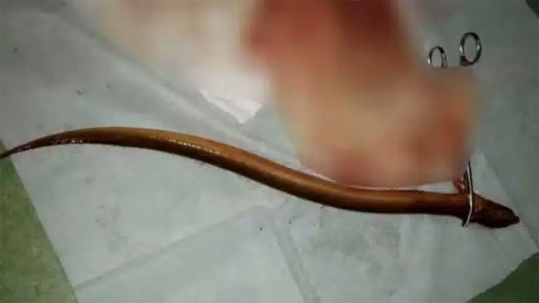 Man Nearly Dies After Shoving Eel Up His Butt To ‘Combat Constipation’