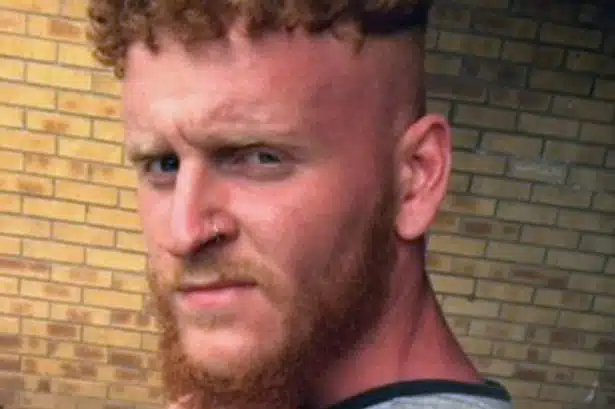 Ginger Dude Suffers Third Degree Burns After Spending Too Much Time In The Sun