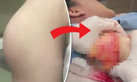 Giant Cyst