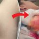 Giant Cyst